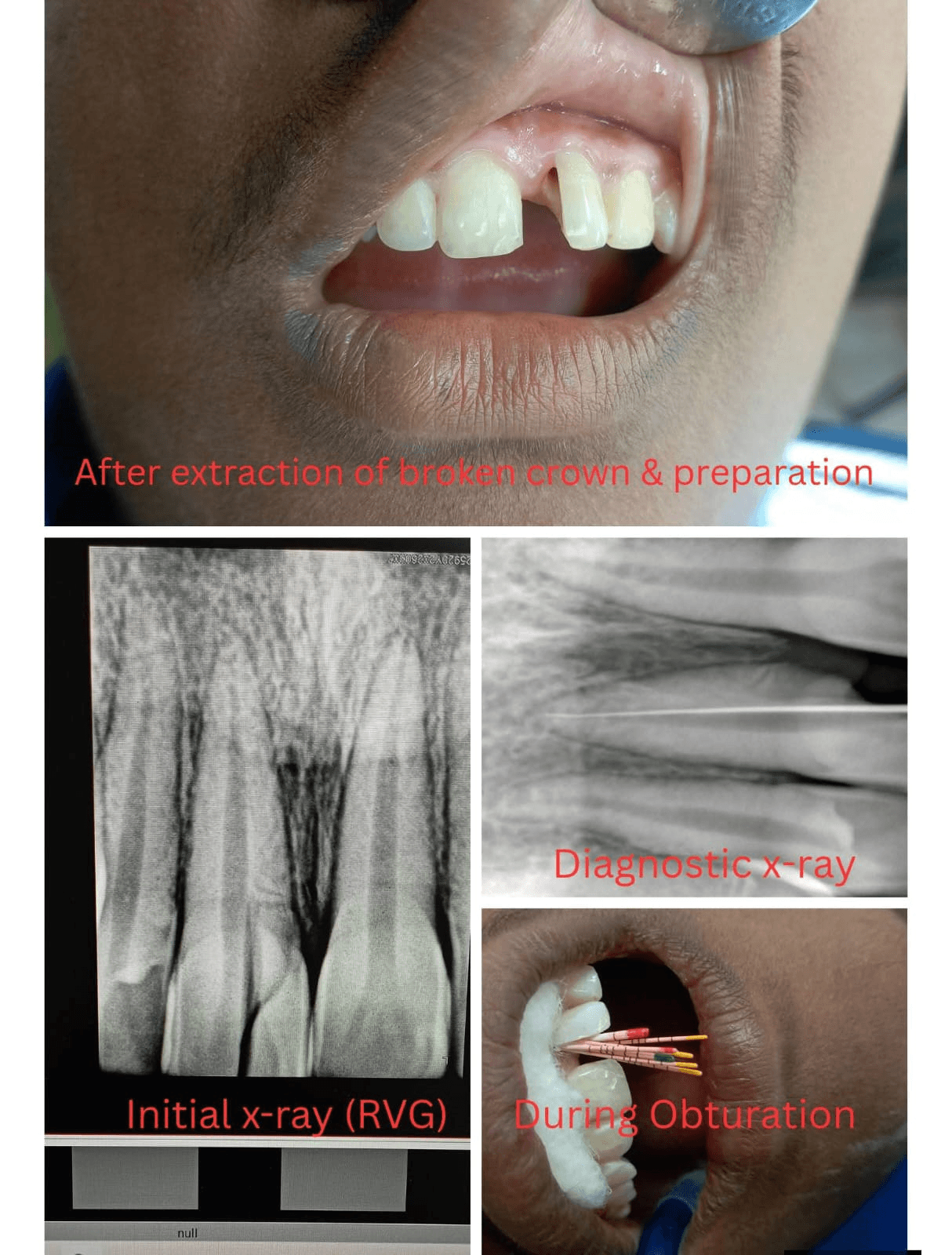 Root Canal Treatment