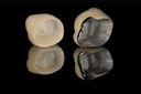 Dental Crowns