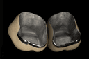 Metal Ceramic Crown
