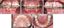 Orthodontic Treatment
