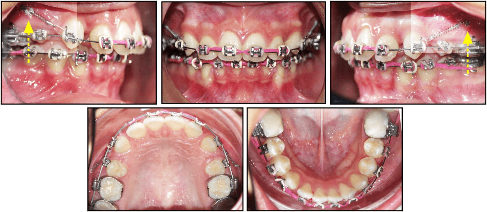 Orthodontic Treatment