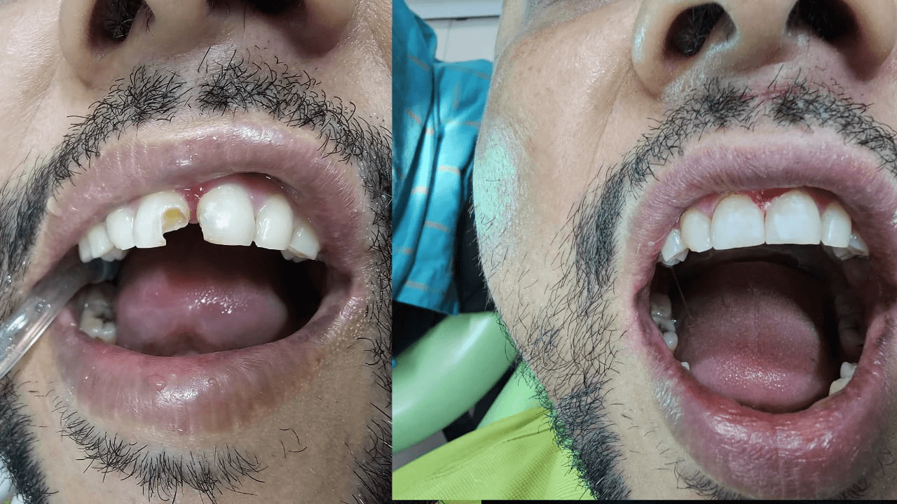 Tooth Restoration Filling