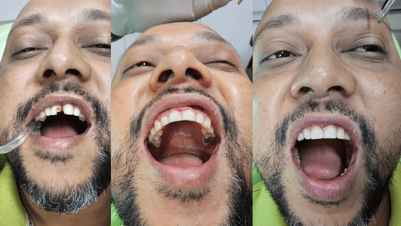 Midline Diastema Closure