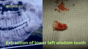 Tooth Extraction