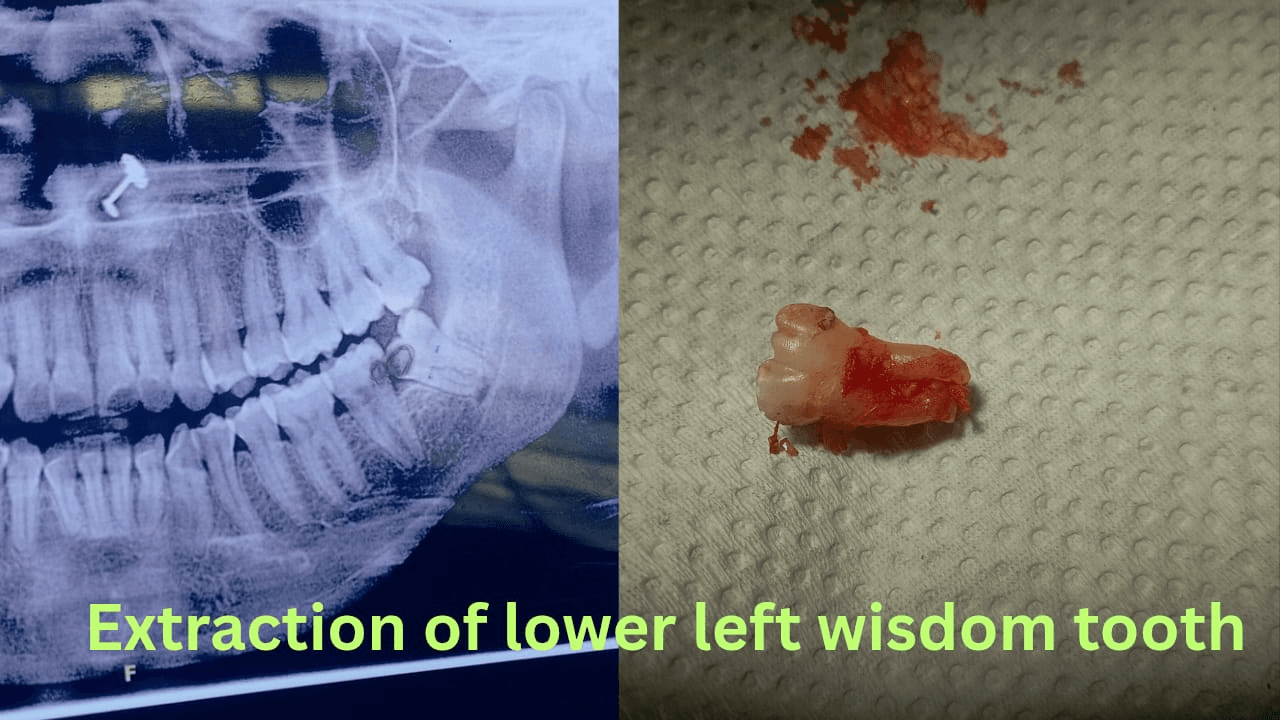 Tooth Extraction