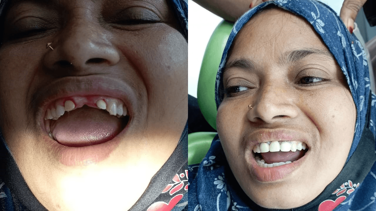 Dental Bridges
