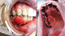 Pyogenic Granuloma Surgery