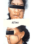 Oral Cancer Management