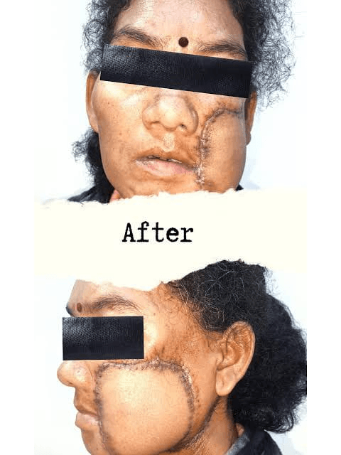 Oral Cancer Management