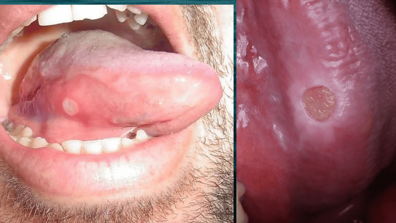 Oral Ulcer Treatment