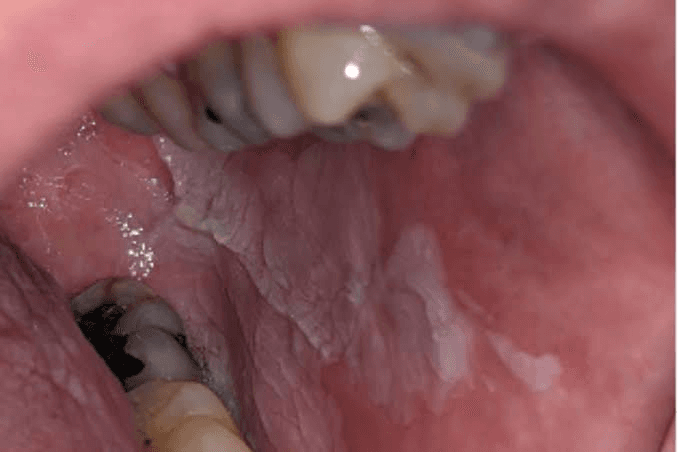 Premalignant Lesion Management