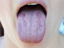 Oral Thrush Treatment
