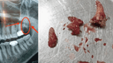 Surgical Tooth Extraction