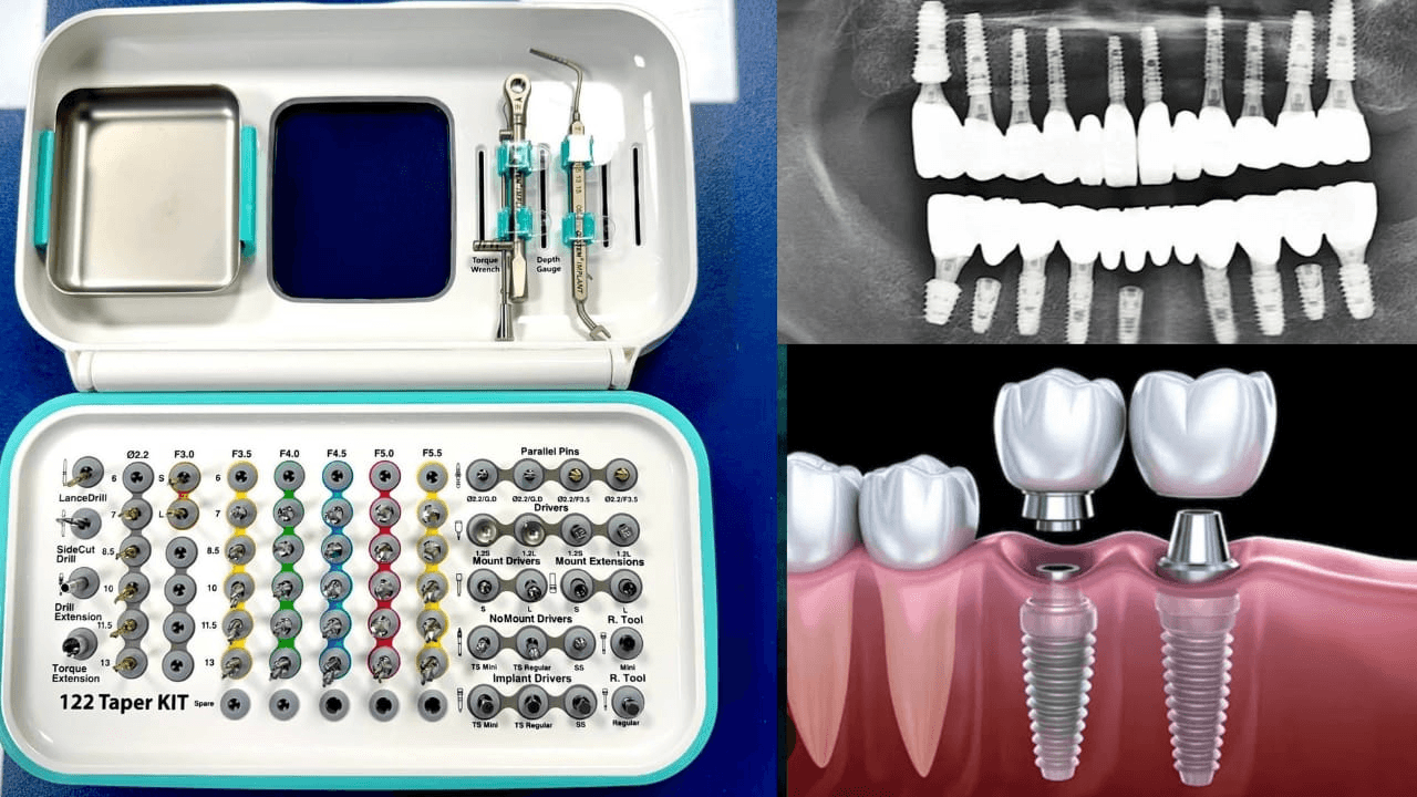 Dental Implants