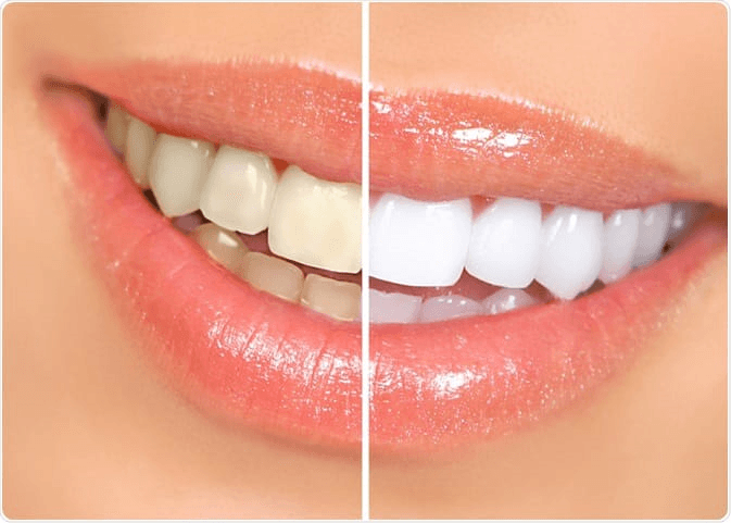 Teeth Whitening (bleaching)