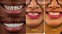 Dental Veneer