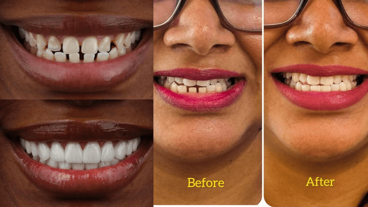 Dental Veneer